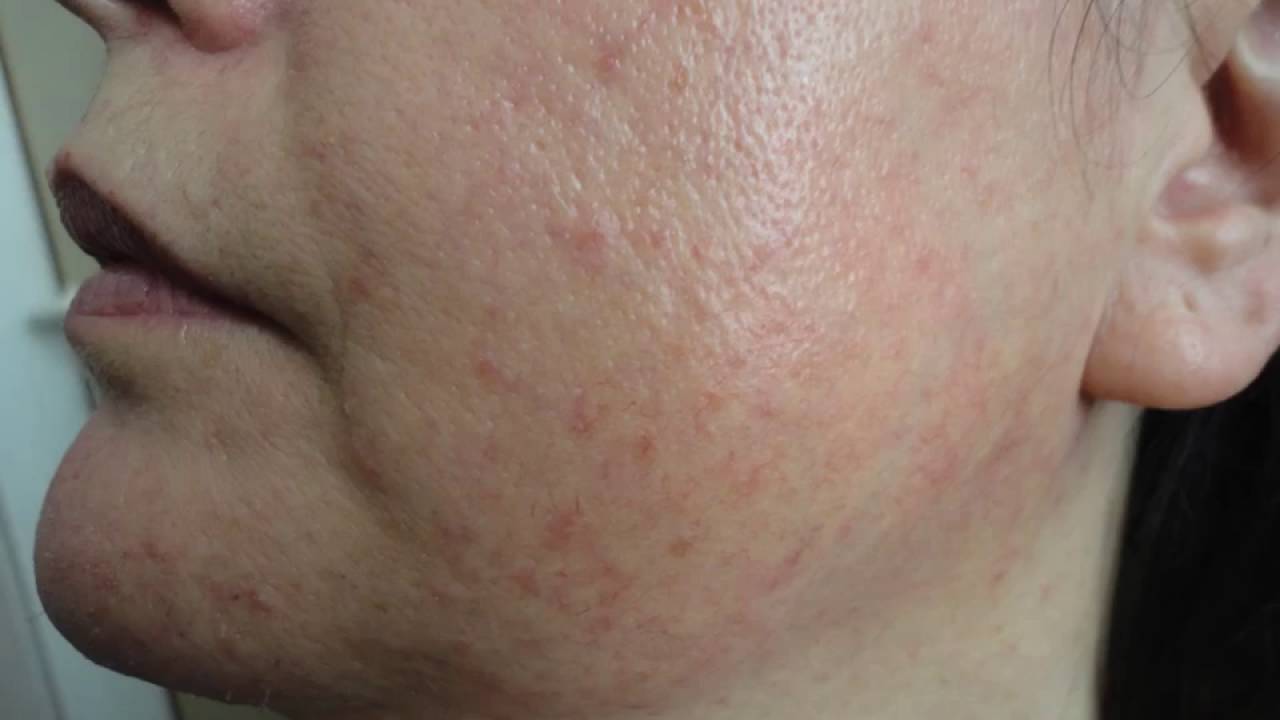 dermalmelasma