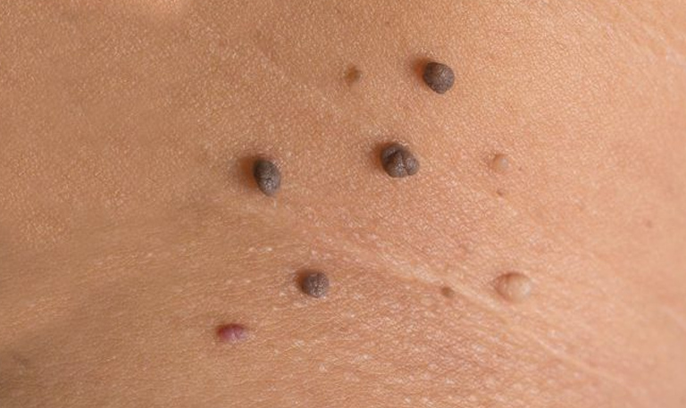 moles
