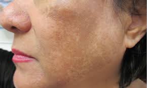 malasma