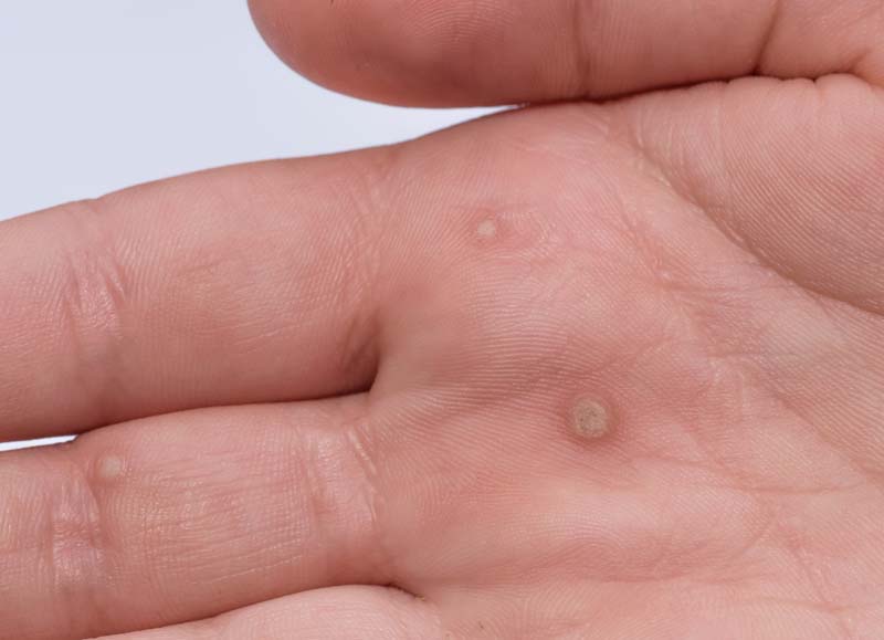 moles